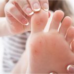 Demystifying Verruca Vulgaris: Causes, Symptoms, and Treatment verruca vulgaris