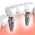 Exploring the Role of a Periodontist: Oral Health Specialists what is a periodontist