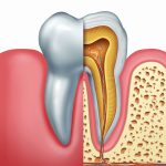 What is Endodontics: Exploring the Vital Role of Tooth-saving Root Canal Therapy what is endodontics