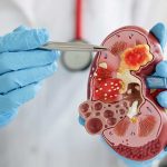 Demystifying Nephrology:The Vital Field of Kidney Health what is nephrology