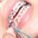 Wondering Where Can I Get My Braces Removed for Free? where can i get my braces removed for free