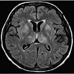 Whipple Disease: the Enigmatic Syndrome Affecting the Body whipple disease
