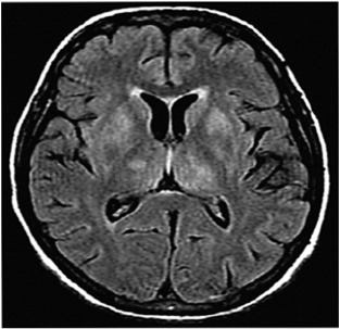 whipple disease