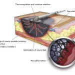 Exploring Wound Vac Therapy: Benefits, Process, and Uses wound vac