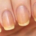 Decoding Yellow Nails: Causes, Treatment, and Prevention Strategies yellow nails
