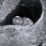 The Miracle Your 8 Weeks Pregnant Ultrasound 8 weeks pregnant ultrasound