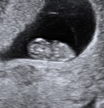 8 weeks pregnant ultrasound