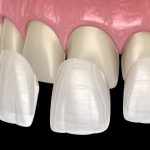 Are Veneers Permanent? Unveiling the Longevity and Maintenance of Dental Veneers Are Veneers Permanent