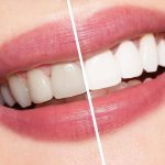 “Brighten Your Smile: Say Goodbye to Yellow Teeth!” Brighten Your Smile