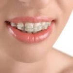 Achieve a Picture-Perfect Smile with Ceramic Braces Ceramic Braces