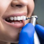 The Disadvantages of Deep Cleaning Teeth You Should Know process of using stomatological brush as a stage of professional dental cleaning procedure in clinic close up