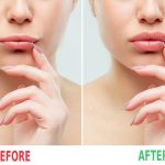 Unlocking Beauty: The Power of Fat Transfer to Lips Fat Transfer to Lips