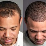 Transformative Journey: Hair Transplant Before and After Hair Transplant Before and After