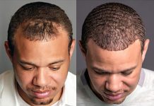 Transformative Journey: Hair Transplant Before and After Hair Transplant Before and After
