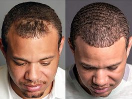 Hair Transplant Before and After