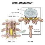 Hemilaminotomy: A Comprehensive Guide to the Spinal Procedure Hemilaminotomy