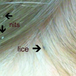 How to Calculate How Long You Have Had Lice How to Calculate How Long You Have Had Lice