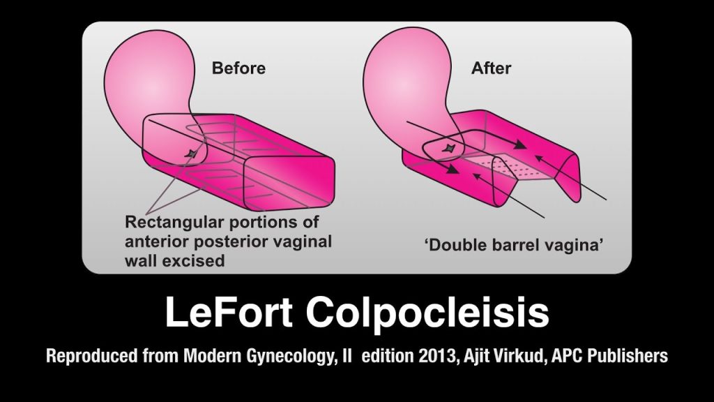 Lefort Colpocleisis