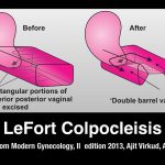 Understanding Lefort Colpocleisis: A Comprehensive Guide to the Procedure Lefort Colpocleisis