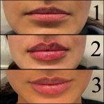 Enhance Your Pout with Lip Shape Lip Fillers: Achieve the Perfect Lip Shape Lip Shape Lip Fillers