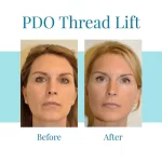 Revitalize Your Gaze: Discover the Magic of PDO Thread Lift for Eyes PDO Thread Lift for Eyes