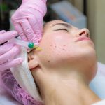PRF Injections for Skin Rejuvenation – Power of Platelets PRF Injection