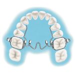 A Confident Smile: Everything You Need to Know About Palatal Expanders Palatal Expander