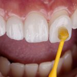 The Ultimate Guide to Permanent Veneers: Transform Your Smile Forever permanent veneers