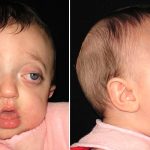 Pfeiffer Syndrome Causes, Symptoms, and Treatment Options Pfeiffer Syndrome