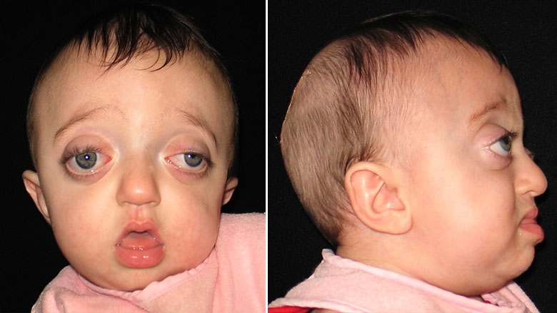 Pfeiffer Syndrome