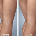 Transformative Journey: Witnessing Sclerotherapy Before and After Sclerotherapy Before and After