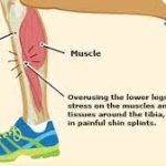 Say Goodbye to Shin Splints: Effective Tips for a Pain-Free Run Shin Splints