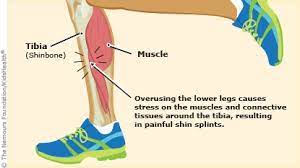 Shin Splints