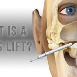 Rising Above: Unveiling the Power of Sinus Lift Surgery Sinus Lift Surgery