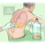 Thoracentesis: A Safe and Effective Procedure for Fluid Removal Thoracentesis