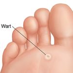 Warts on Feet: Causes, Treatment, and Prevention Warts on Feet