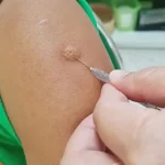 Where Can I Get a TB Test? Where Can I Get a TB Test