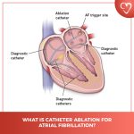 Ablation for AFib: Regaining Rhythm and Peace of Mind ablation for afib