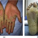 The Potential of Acitretin A Comprehensive Guide acitretin