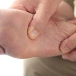 Demystifying Acral Lentiginous Melanoma: Signs, Symptoms, and Treatment acral lentiginous melanoma