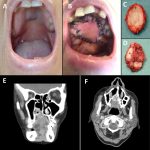 Adenoid Cystic Carcinoma a Rare Salivary Gland Cancer adenoid cystic carcinoma