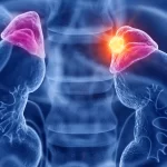 Decoding Adrenal Adenoma: Symptoms, Diagnosis, and Treatment adrenal adenoma