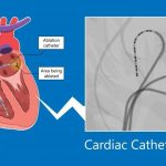 The World of Afib Ablation A Comprehensive Guide afib ablation