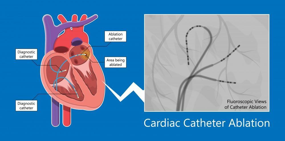 afib ablation