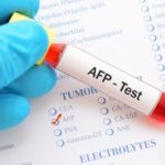 AFP Test What You Need to Know afp test