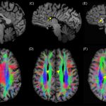 Agenesis of the Corpus Callosum A Fascinating Brain Anomaly agenesis of the corpus callosum