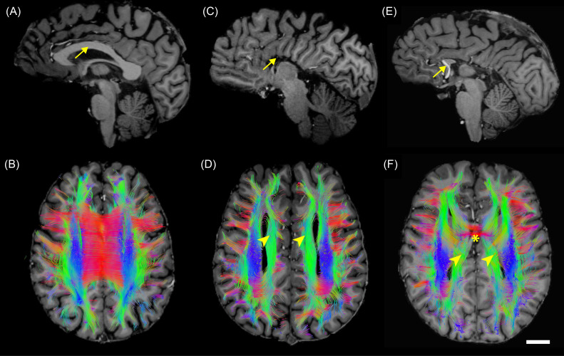 agenesis of the corpus callosum