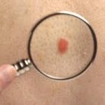 Cracking the Code of Amelanotic Melanoma: Detecting the Hidden Threat amelanotic melanoma