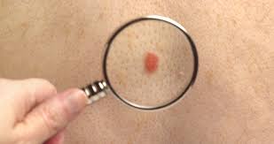 amelanotic melanoma