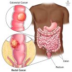 Anal Cancer Symptoms: Signs to Watch For anal cancer symptoms